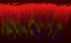 Gold nanorod contrast enhanced Optical Coherence Tomography images of a human breast carcinoma tissue sample. The sturcutral OCT image is presented in red, and the SOCT computed GNR density is presented in green.